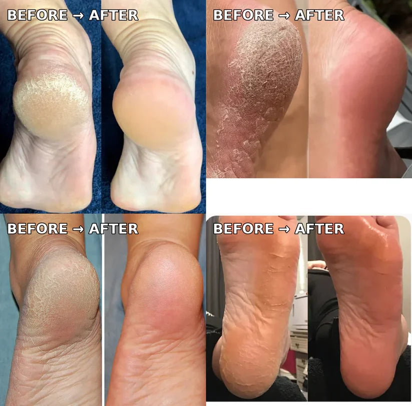Electric Callus Remover
