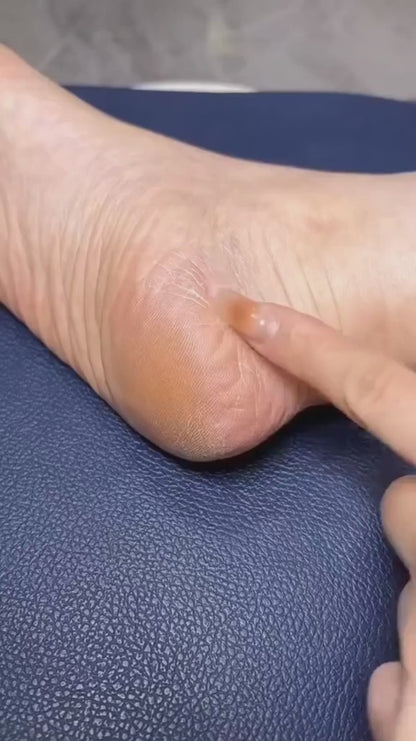 Electric Callus Remover